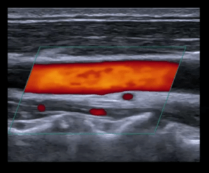 Carotid ultrasound screening