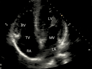 Heart screening Echocardiogram. Evaluate anatomy and function.