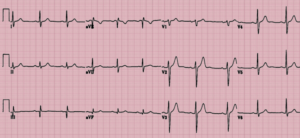 Heart screening with Electrocardiogram. Rhythm evaluation.