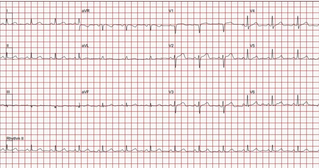 EKG
