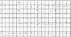 Abnormal electrocardiogram