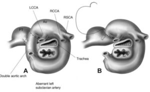 Vascular ring with airway compression