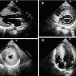 Hypertrophic cardiomyopathy