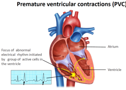 Premature Ventricular Contractions (PVCs)