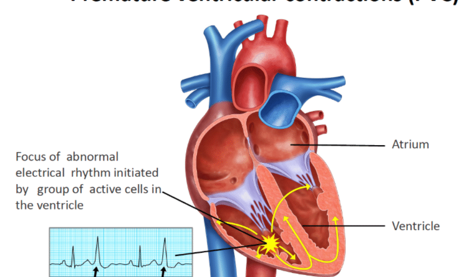 Premature Ventricular Contractions (PVCs)